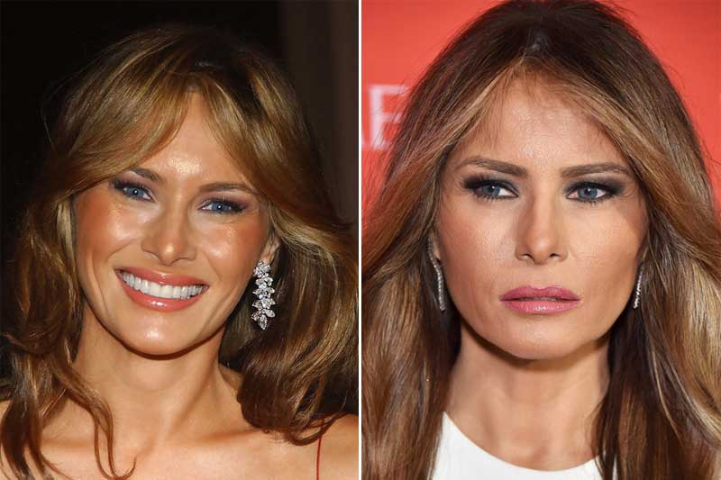 El doctor Fabio Vieira analiza con minuciosidad los cambios estéticos de Melania Trump