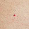 angiomas